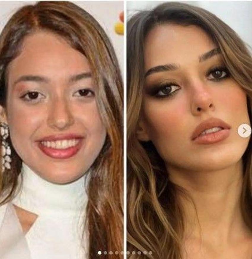 Dilan Çiçek Deniz estetiksiz haliyle gündemde! 
