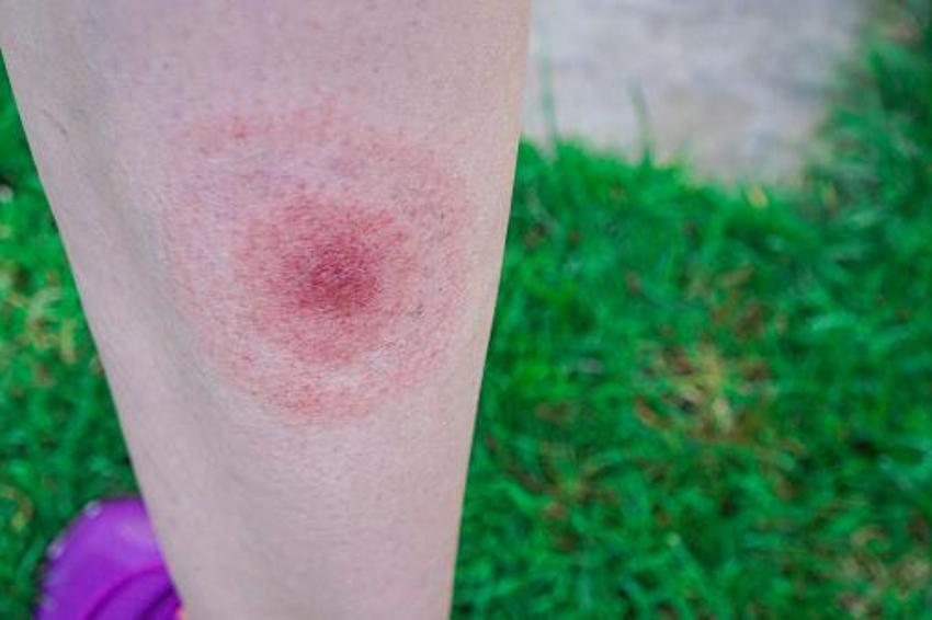 Sessiz pandemi "Lyme" 350 hastalığı taklit ediyor! 10 milyon kişide var