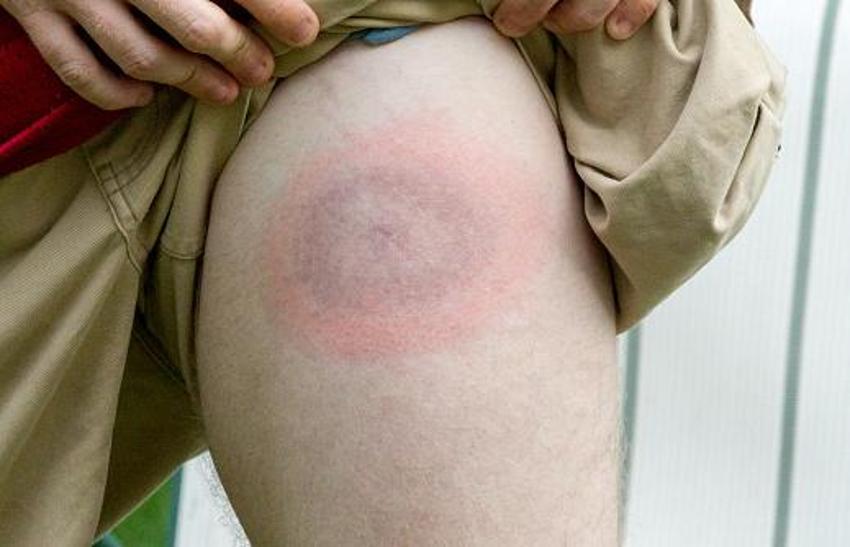 Sessiz pandemi "Lyme" 350 hastalığı taklit ediyor! 10 milyon kişide var