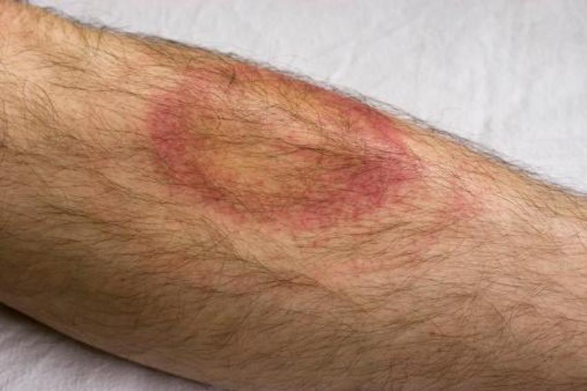 Sessiz pandemi "Lyme" 350 hastalığı taklit ediyor! 10 milyon kişide var