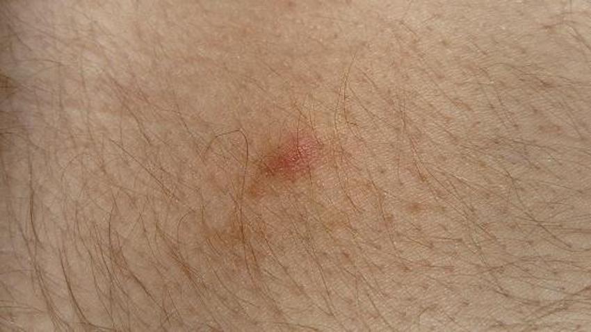 Sessiz pandemi "Lyme" 350 hastalığı taklit ediyor! 10 milyon kişide var