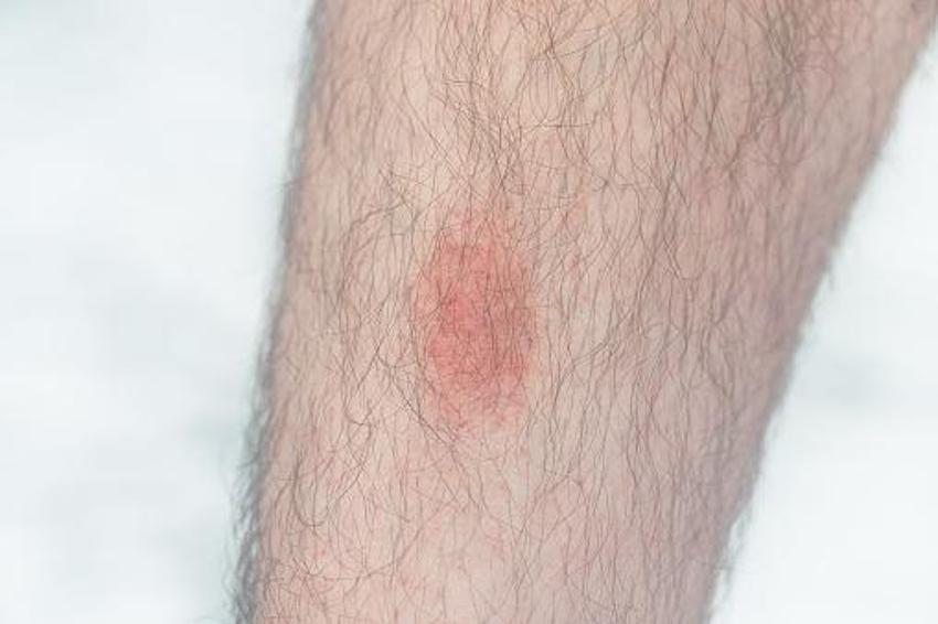 Sessiz pandemi "Lyme" 350 hastalığı taklit ediyor! 10 milyon kişide var