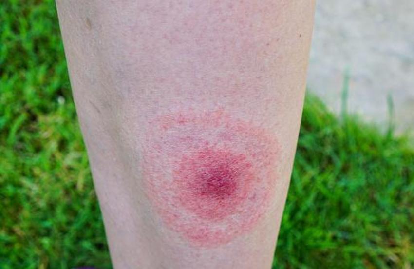 Sessiz pandemi "Lyme" 350 hastalığı taklit ediyor! 10 milyon kişide var