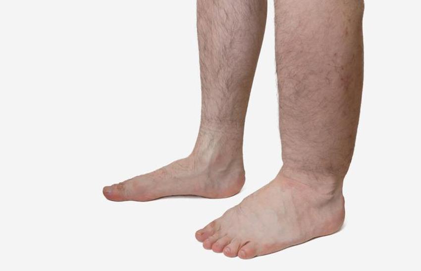 Fil hastalığı nedir, neden olur, belirtileri nelerdir? Lenfödem (Fil hastalığı) bulaşıcı mı, tedavisi nedir, geçer mi?