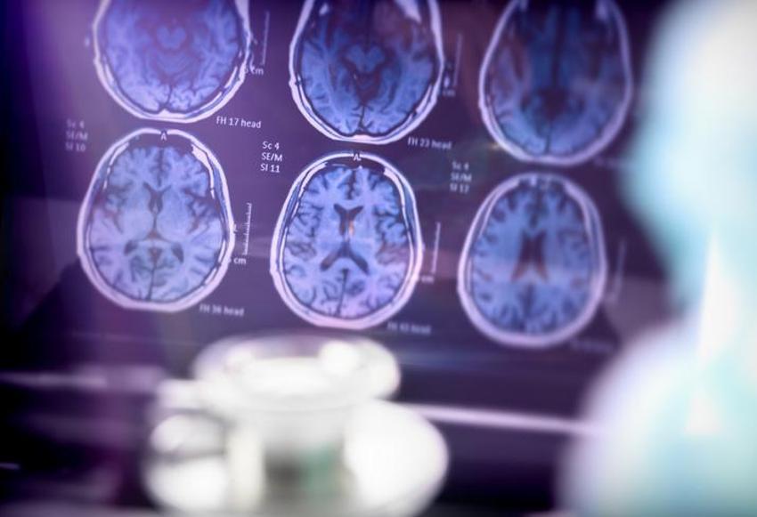 Alzheimer'ın ana sebebi! Bu alışkanlıklar hastalığı tetikliyor