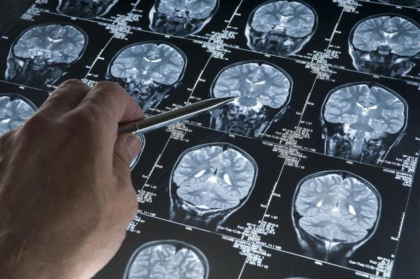 Alzheimer'ın ana sebebi! Bu alışkanlıklar hastalığı tetikliyor