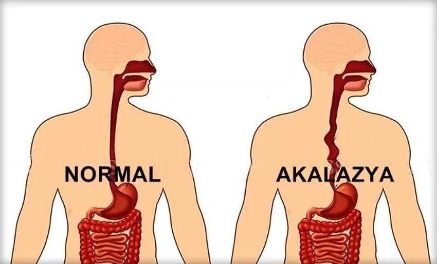 Sinsice ilerliyor, yutmayı zorlaştırıyor! Bu hastalık ilk kez ortaya çıkmadı ama giderek yayılıyor!
