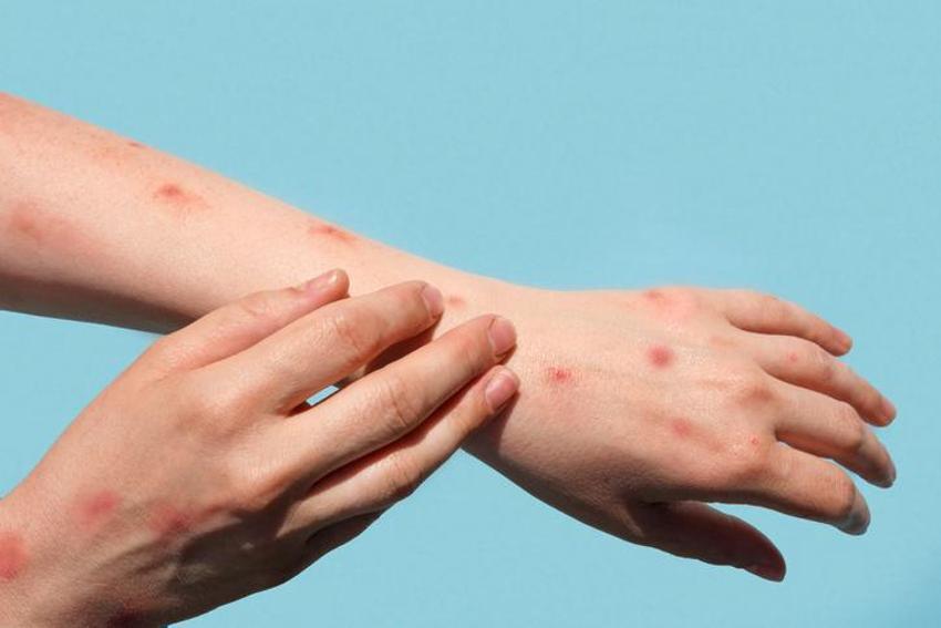 (Kızamık salgını) Kızamık nasıl bulaşır, kızamık aşısı olan kızamık olur mu? Yetişkinlerde ve bebeklerde kızamık aşısı belirtileri nelerdir?