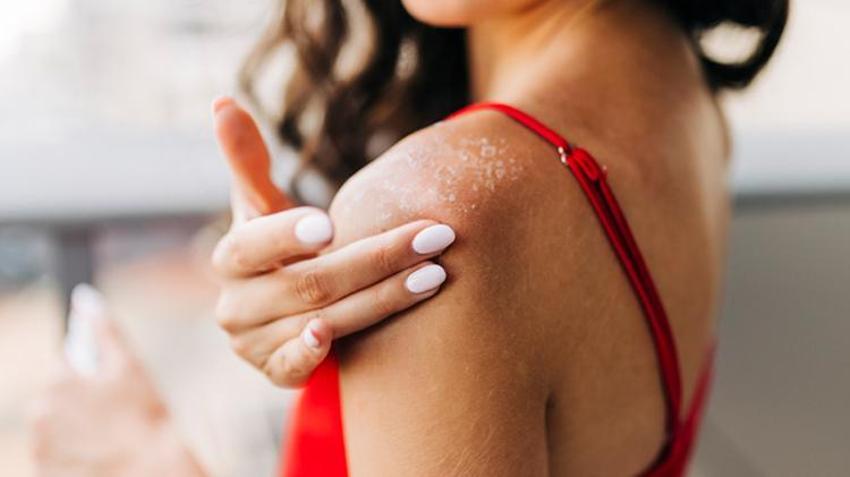 Güneş yanığına iyi geliyor, cildi serinletiyor!  Hepsi doğal çözüm