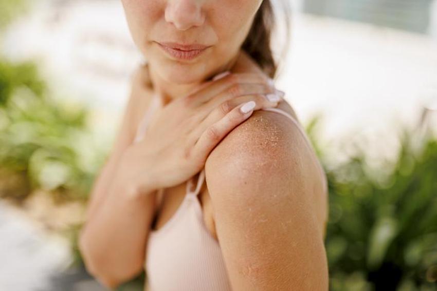 Güneş yanığına iyi geliyor, cildi serinletiyor!  Hepsi doğal çözüm