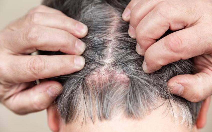 Saç dökülmesini bıçak gibi kesiyor, parlak bir görünüm veriyor! Hepsi A, C, E, B5, B6 ve B12 vitaminleri bakımından çok zengin...  