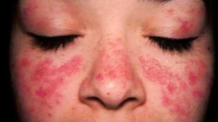 Kelebek hastalığı (LUPUS) nedir? Pozitif Lupus hastalığının tedavisi var mı, kelebek hastalığı belirtileri nelerdir?
