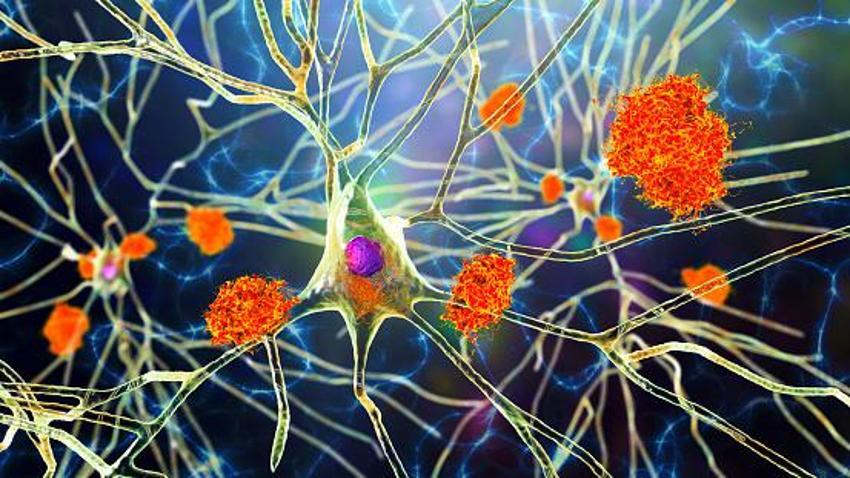 Vücudunuz Alzheimer'ı 15 yıl önceden haber veriyor! Hemen kontrol edin