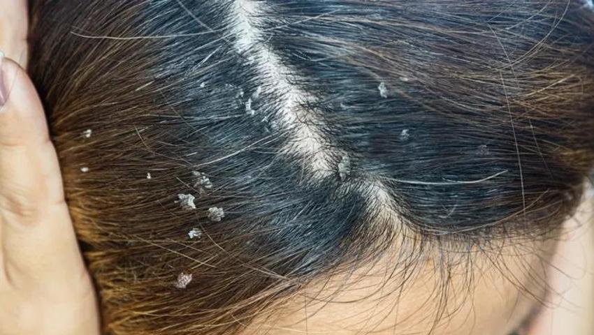 Bu hata saç derisinde yaralara neden oluyor! Banyodan çıktığınız anda kepek oluyorsa dikkat!