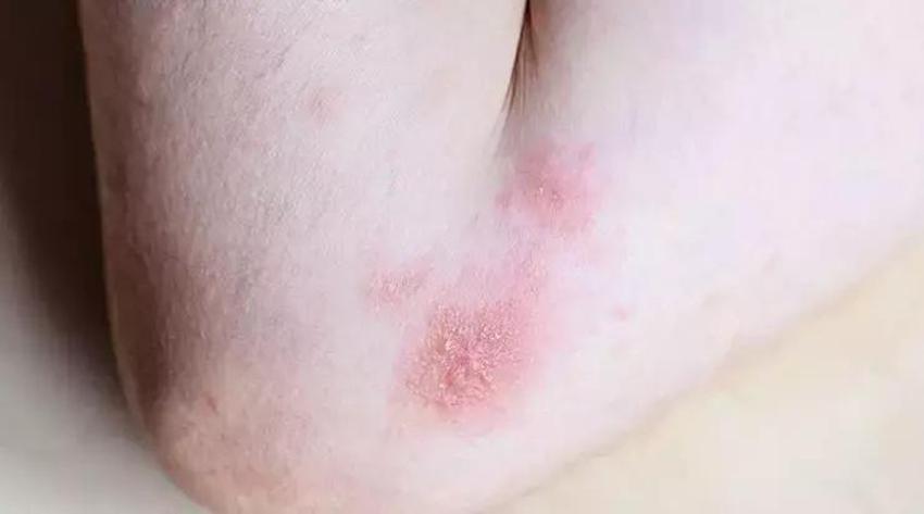 Sivilceleri kolunuzdan nasıl temizlersiniz? Basit yöntem: Bakteri üreten bu hatayı yapmayın