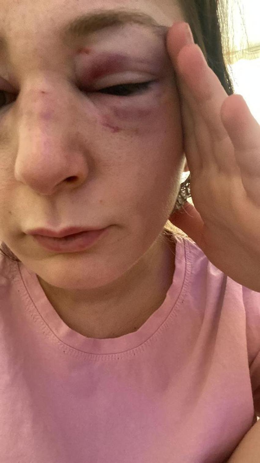 Kafa attı vücudunda sigara söndürdü! Eski sevgili dehşeti kan dondurdu