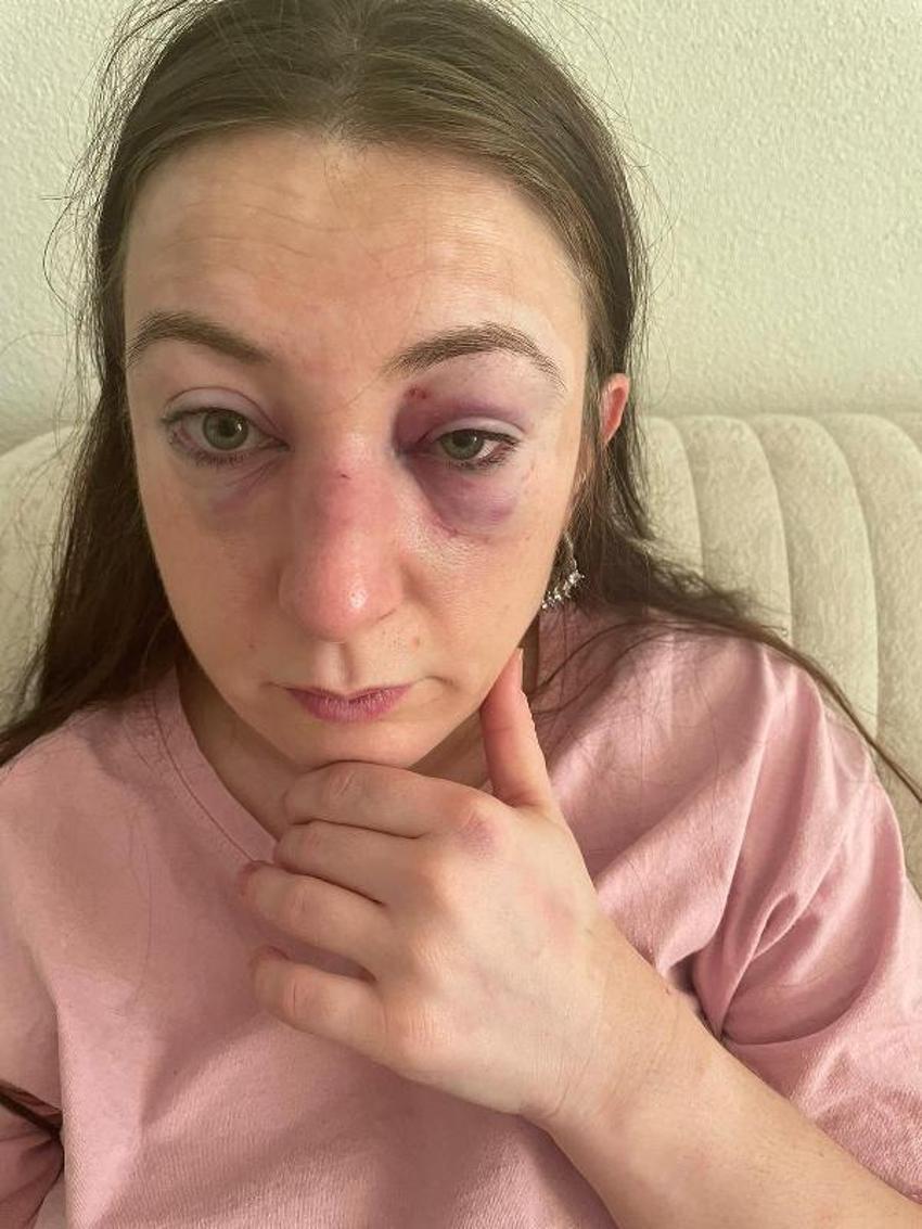 Kafa attı vücudunda sigara söndürdü! Eski sevgili dehşeti kan dondurdu