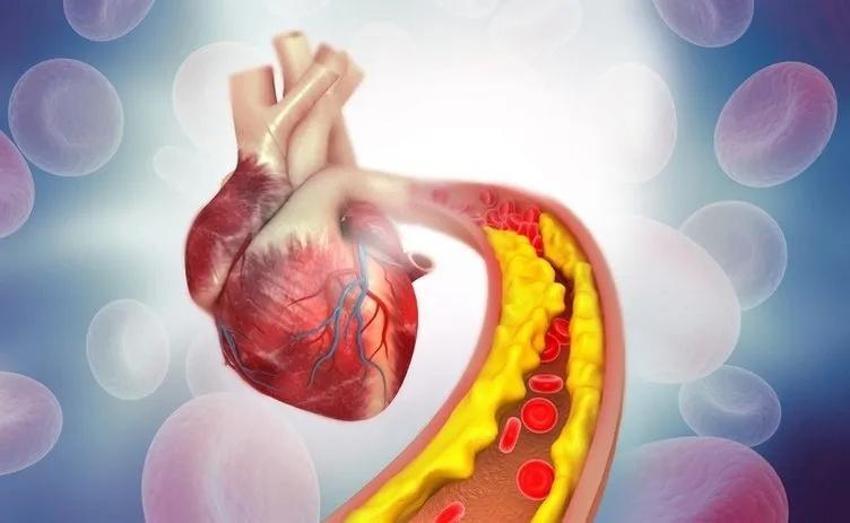 50 gramı kalbinizi saat gibi işletiyor! Bu formül, yüksek kolesterolü düşürmek için, düşük yoğunluklu lipoprotein (LDL) düzeylerini azaltmaya yardımcı oluyor!