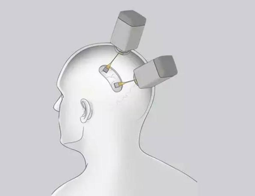 Neuralink beyin çipi nedir? Neuralink ne işe yarar, Neuralink çipi nasıl çalışıyor? Elon Musk Neuralink projesi