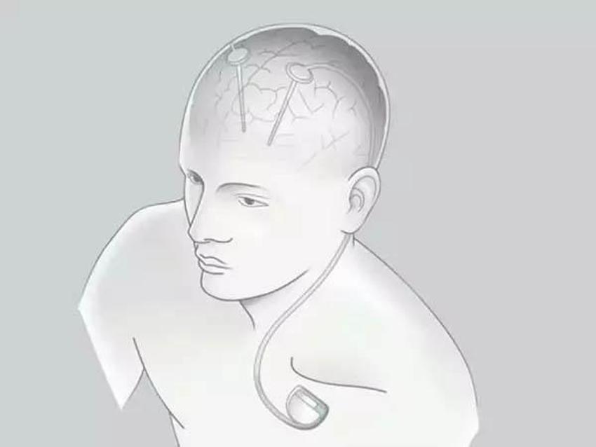 Neuralink beyin çipi nedir? Neuralink ne işe yarar, Neuralink çipi nasıl çalışıyor? Elon Musk Neuralink projesi