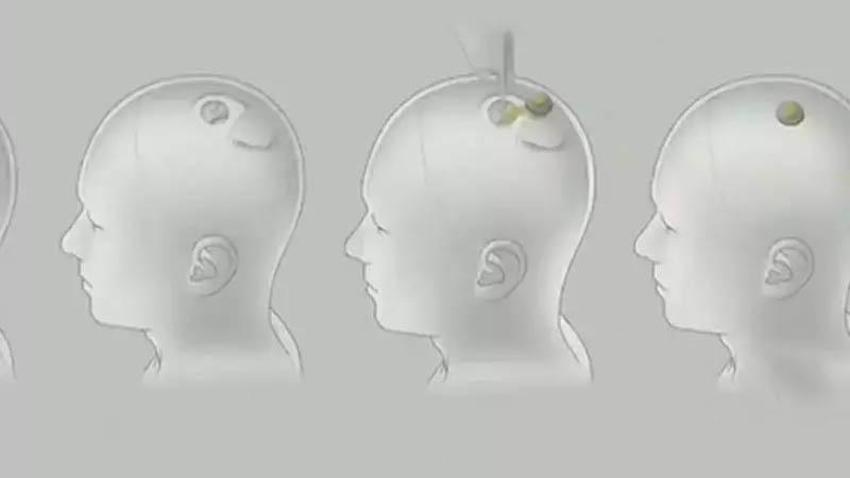 Neuralink beyin çipi nedir? Neuralink ne işe yarar, Neuralink çipi nasıl çalışıyor? Elon Musk Neuralink projesi