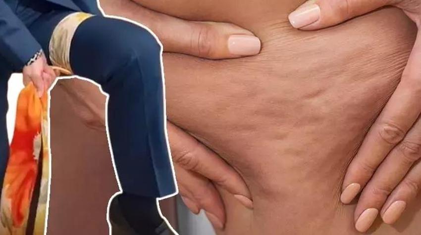 Selülitten kurtaran eşarp yöntemi: Çin tıbbında yüzyıllardır kullanılıyor! Evde egzersizle 3 haftada sonuç veriyor
