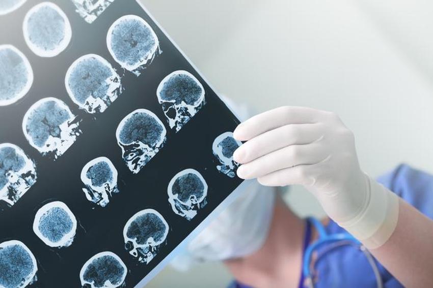 Epilepsi genci yaşlısı demiyor! 20’li ve 60’lı yaşlara dikkat!