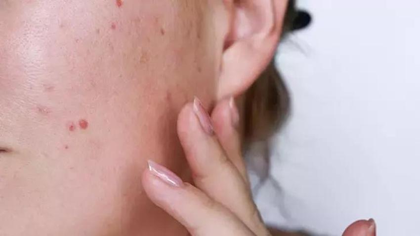 Sivilcelere kesin çözüm ev yapımı karışımda: Her gün 2 bardaktan sonra eser kalmıyor
