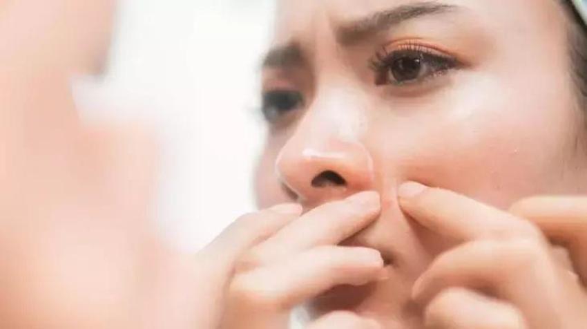 Siyah noktaları vakum gibi çeken yöntem: Evde iki malzemeyle hazırlanıyor!