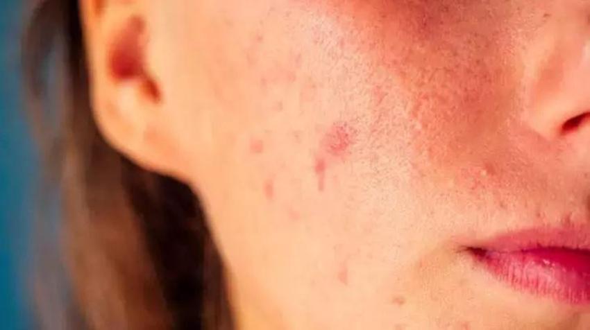 Kozmetik ve makyajda fazla ürün kullanımı cilt bariyerini 18 yaşında yok ediyor