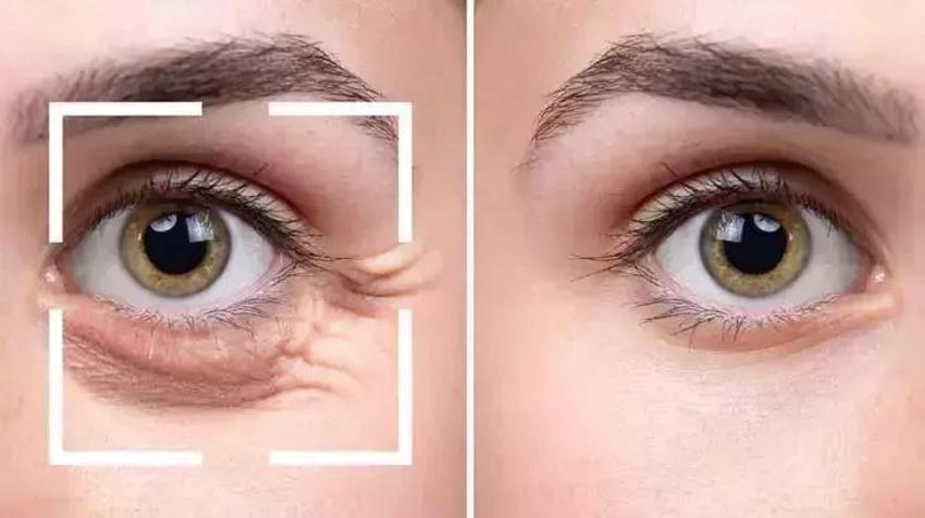 Göz altı halkalarını, morluklarını bu masajla yok edin; sadece 2 malzeme yetiyor
