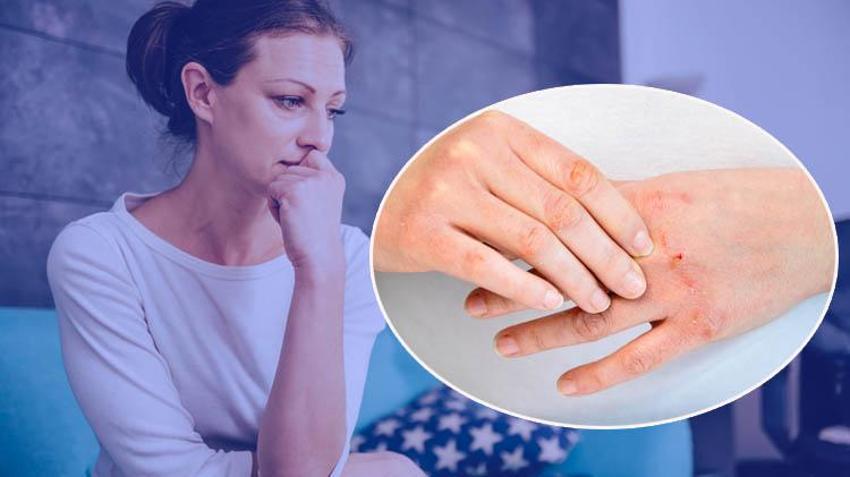 Nedeni bilinmiyor, fiziksel hasara yol açıyor! Uzmanı uyardı: Yüz, kollar, bacaklar ve tırnak etleri hedeflenir