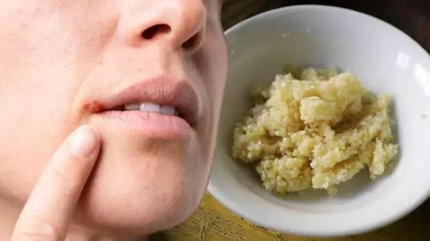 Uçuk geçiren doğal yöntemde süre sadece 10 dakika - Virüs, bakteri ve mantarı yakıp kavuruyor