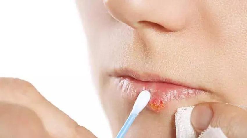 Uçuk geçiren doğal yöntemde süre sadece 10 dakika - Virüs, bakteri ve mantarı yakıp kavuruyor