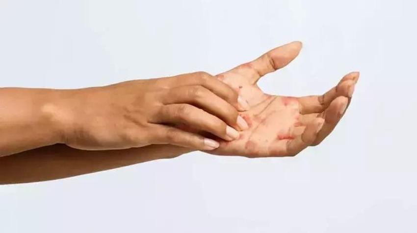 Egzamayı, döküntüyü çaresiz bırakıp son veriyor! İki malzemeyi de sürüp bekletin: Meğer yıllarca gözümüzün önünde duruyormuş!