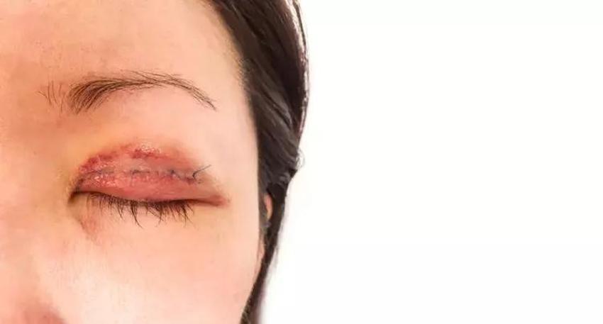 Gerçeği uyanınca öğrendi! Enfeksiyon sandılar ancak nadir görülen bir hastalık çıktı, doktolar önce gözünü kesti!