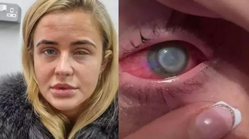 Kaşıntıyla başladı, 22 yaşında gözünün rengi değişti! Meğer tek yaptığı şey gözünü kör etmiş