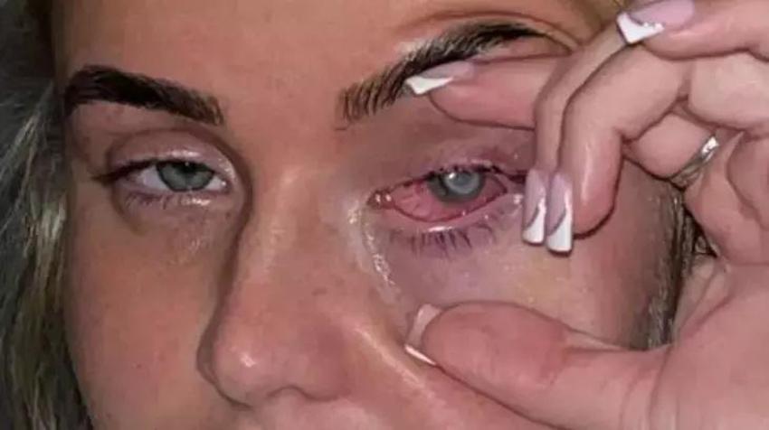 Kaşıntıyla başladı, 22 yaşında gözünün rengi değişti! Meğer tek yaptığı şey gözünü kör etmiş