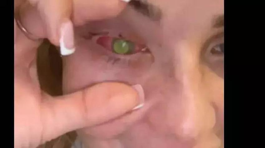 Kaşıntıyla başladı, 22 yaşında gözünün rengi değişti! Meğer tek yaptığı şey gözünü kör etmiş