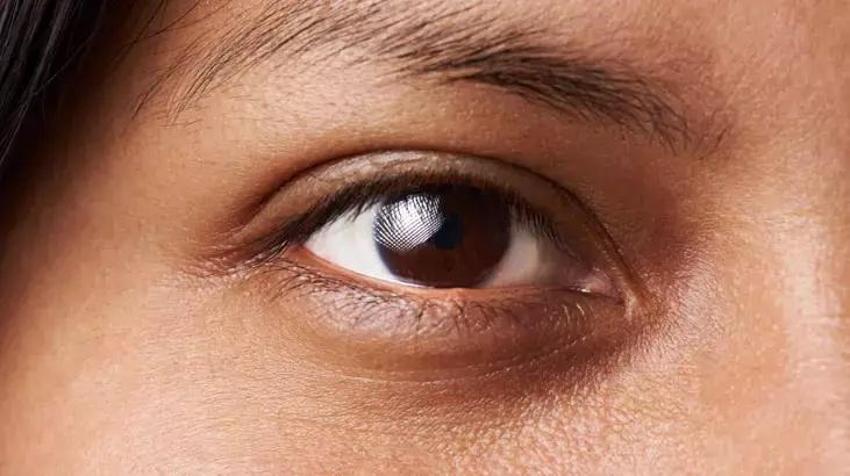 Doğduğundan beri göz altı morlukları vardı; çareyi o yağda buldu: "Tek bir morluk bırakmadı"