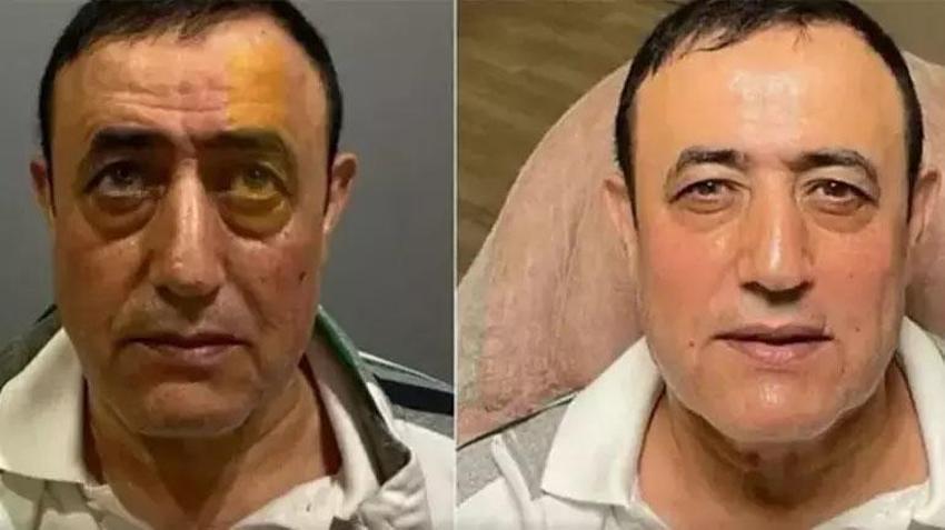Mahmut Tuncer estetik yaptırdı! ‘Mahmut El Roman’