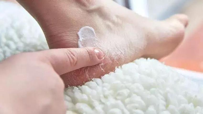 Ayak tabanında topuklarda çatlaklara karışım var! Limona eklenince kat kat hızlı yumuşuyor