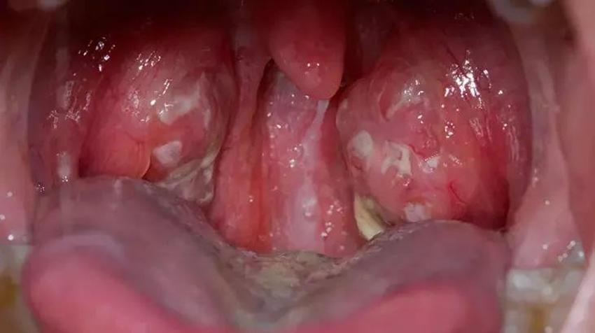 1 çorba kaşığı kadar ağızda çalkalayın! Ağız kokusu da nedeni de ortadan kalkıyor