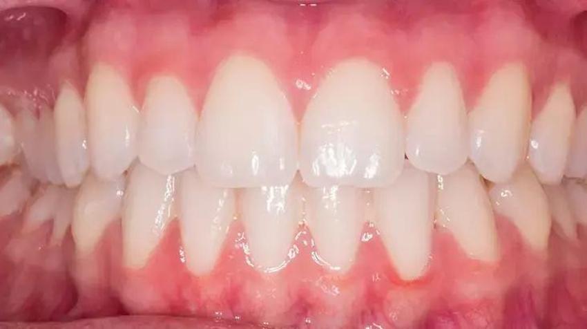 1 çorba kaşığı kadar ağızda çalkalayın! Ağız kokusu da nedeni de ortadan kalkıyor