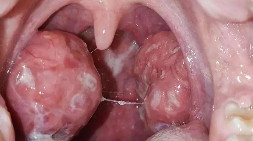 1 çorba kaşığı kadar ağızda çalkalayın! Ağız kokusu da nedeni de ortadan kalkıyor