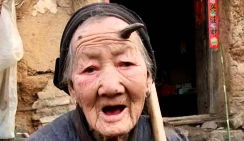 76 yaşındaki kadının alnında boynuz çıktı, çenesine kadar uzandı! 20 santimlik boynuzun nedeni dünyayı şaşkına çevirdi!