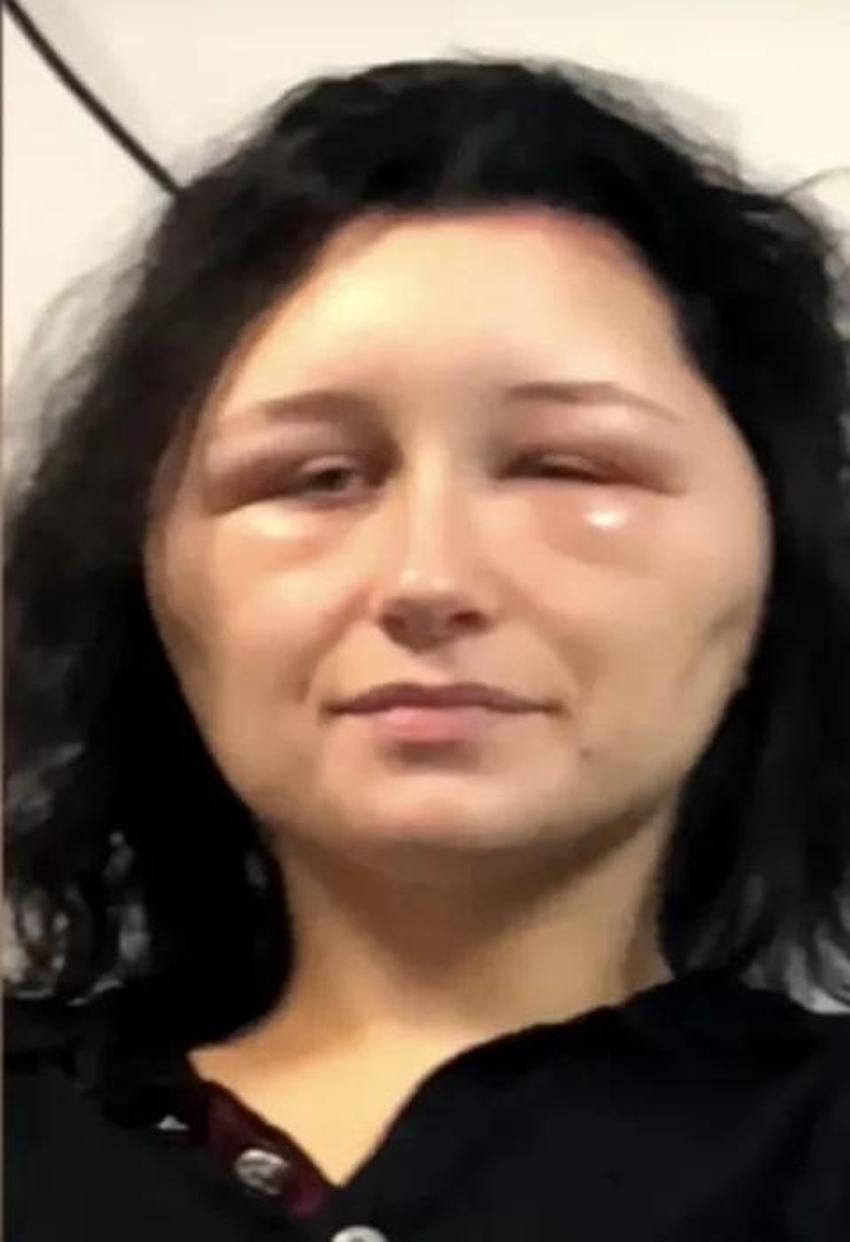 Saç rengini değiştirmek istedi, kafası ampül şeklini aldı! Korkunç olayın nedeni meğer...
