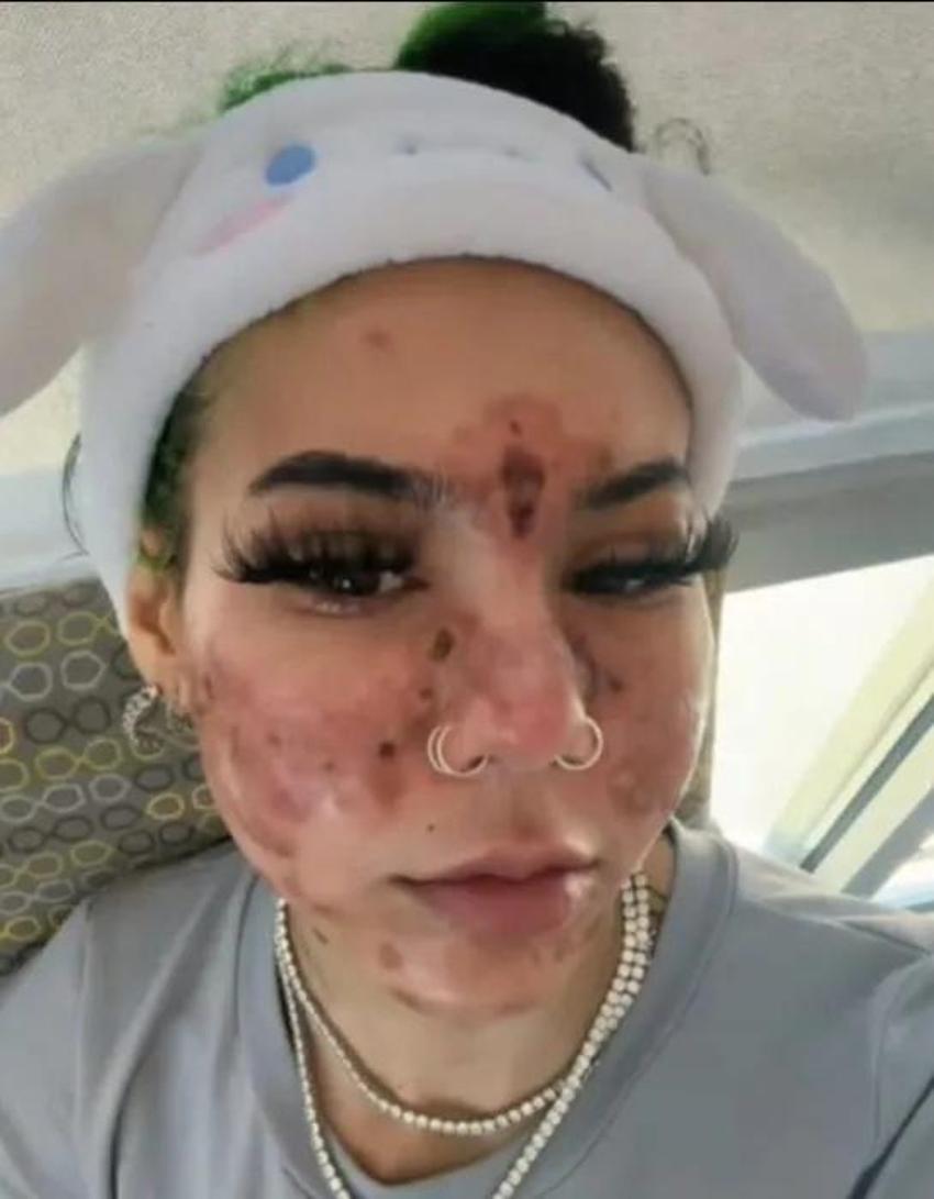 Evde yüz maskesi yaptı, yüzünü kaybetti! Bu ürünleri çöpe atın: Plastik cerrahlar kesin uyardı!