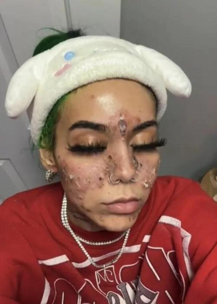 Evde yüz maskesi yaptı, yüzünü kaybetti! Bu ürünleri çöpe atın: Plastik cerrahlar kesin uyardı!
