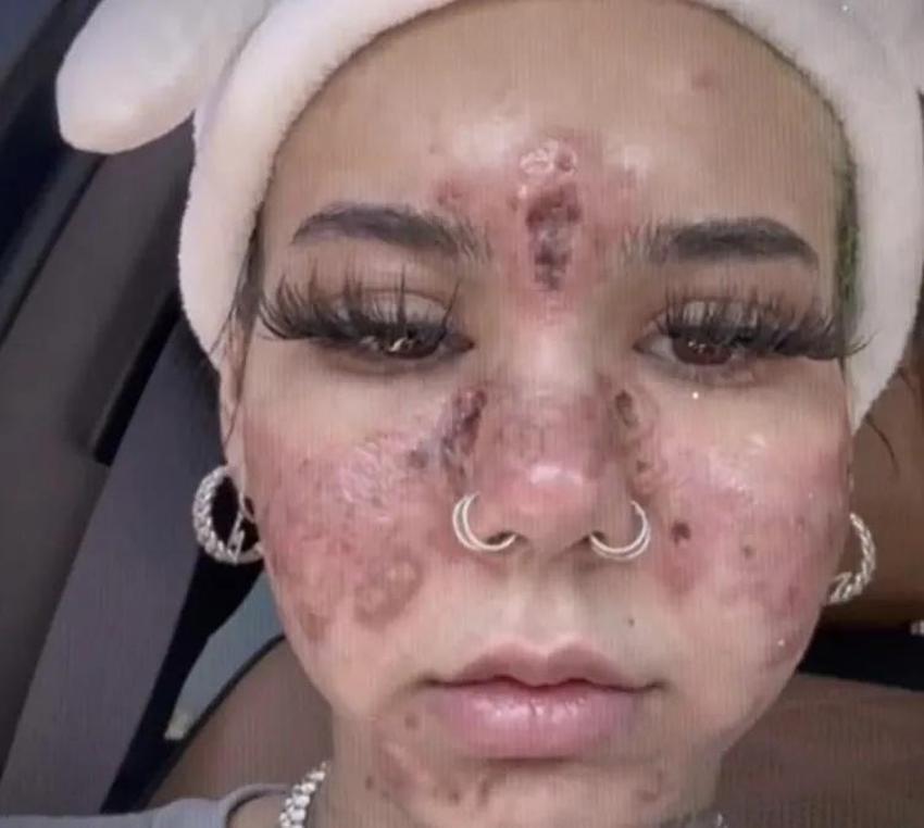 Evde yüz maskesi yaptı, yüzünü kaybetti! Bu ürünleri çöpe atın: Plastik cerrahlar kesin uyardı!